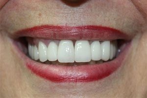 Smile 2 after