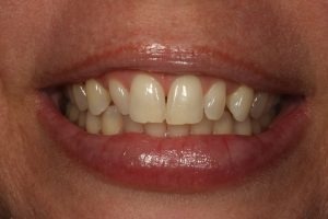 Smile before
