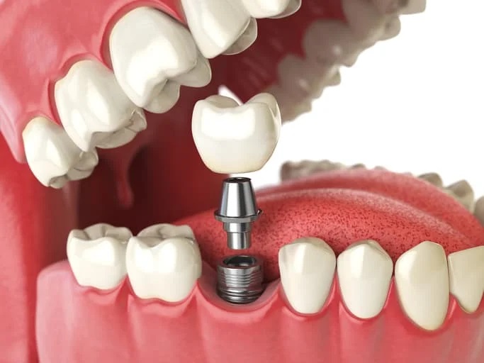 Dental Implants - Folsom Family Dentistry